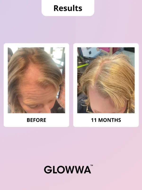Hair growth comparison: before and after 11 months.