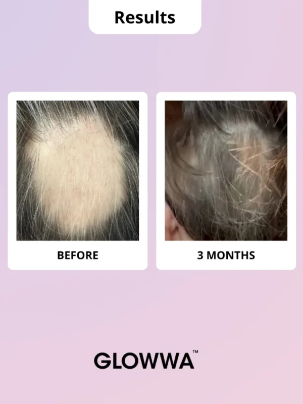 Hair growth results after three months use